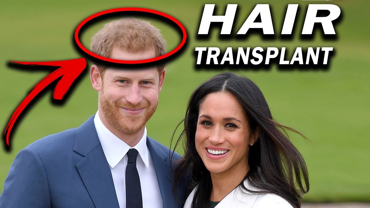Prince harry losing hair ginger